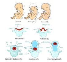 neural tube defects